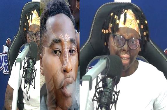 VIDEO: Lady whose lover poured acid on her details how it happened