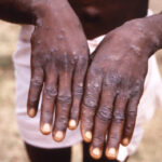 Ghana Records 1,038 Mpox Cases and Eight Deaths – Health Minister