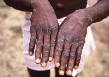 GhiSEP issue guidelines to curb spread of Mpox